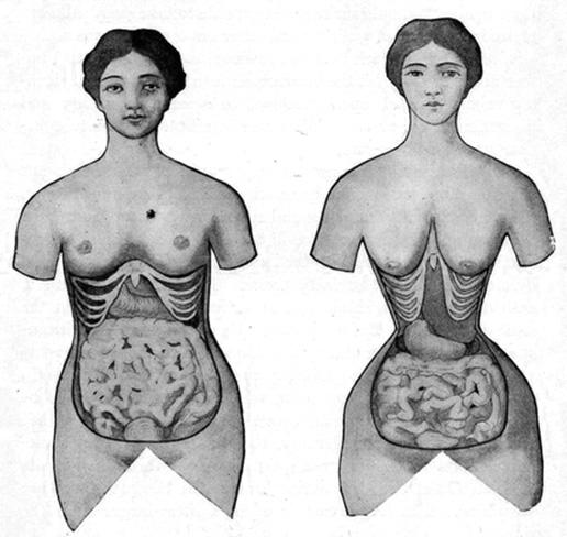 Waist training brings back a Victorian-era fad – Basement Medicine